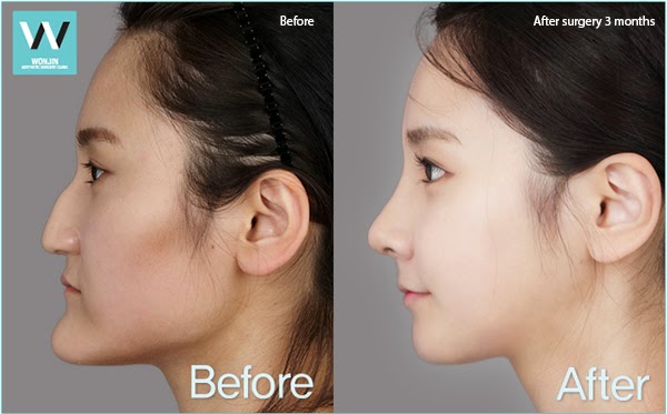 File:Look at me two jaw makeover before and after 03.JPG