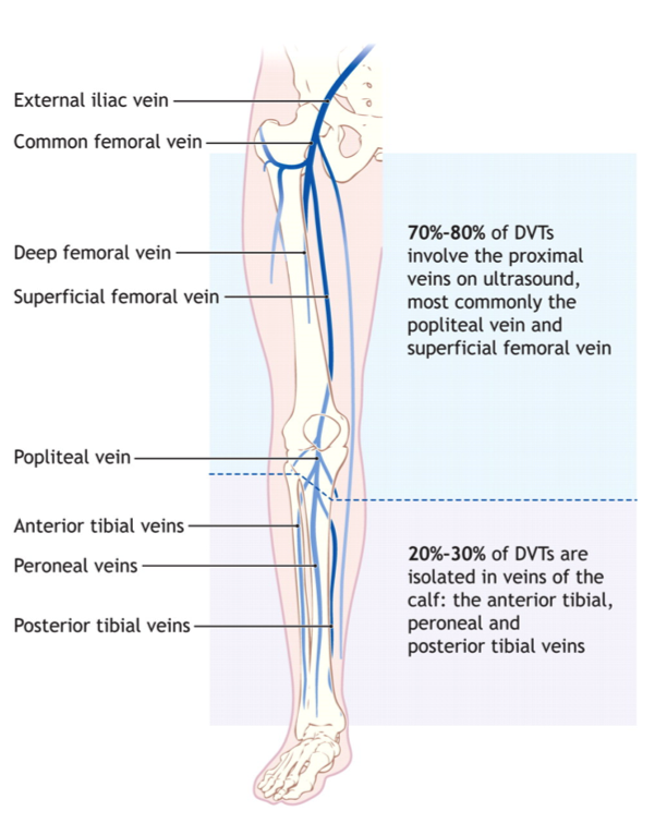 DVT Lower extremity.png