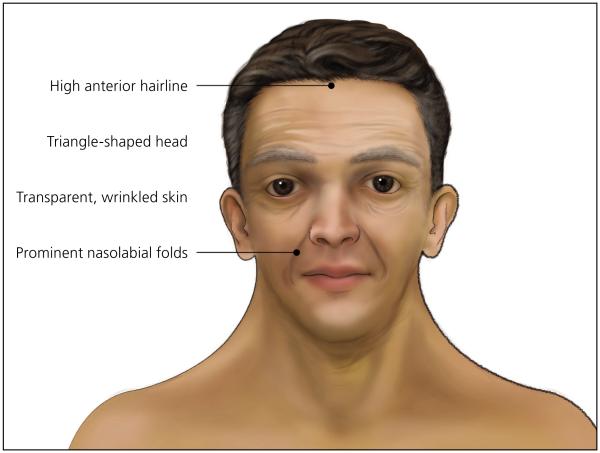 File:Adult with Noonan Syndrome.jpg