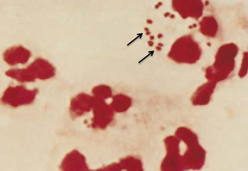 File:Gram Stain of N. meningitides with Associated Peripheral Mononuclear Cells.jpg