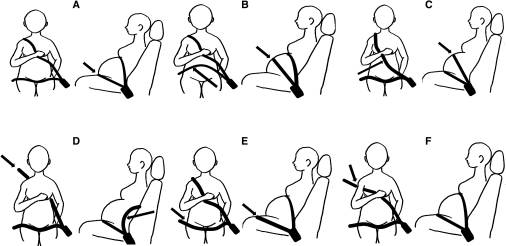 File:Various ways of wearing a seatbelt for pregnant people.jpg