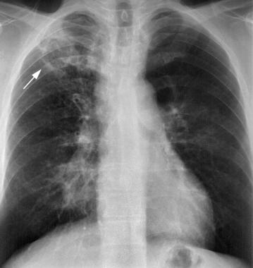 File:Chest X-ray or Radiograph showing signs of TB.jpg