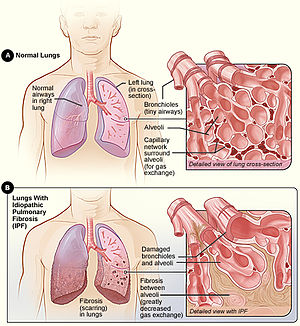 Figure 3. Normal Lungs vs. Lungs with Pulmonary Fibrosis