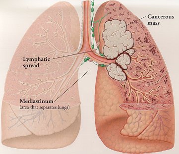 File:Lungcancer.jpg