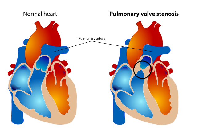 File:Pulmonary valve stenosis.png