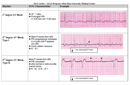 File:ACLS 1st 2nd degree AVB.png