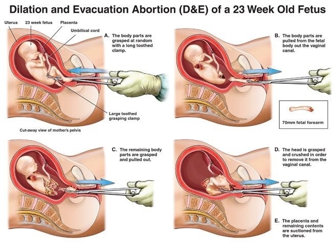 Dilation and Evacuation Abortion (D&E) of a 23 Week Old Fetus.jpg