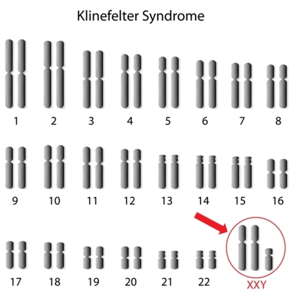 File:Klinefelter-syndrome-karyotype.jpeg
