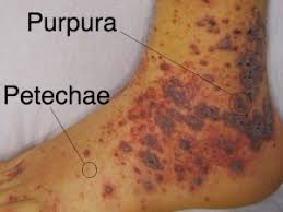 File:Severe Purpura and Petechiae presentation on the skin.jpg