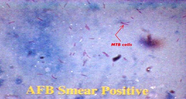 File:Nucleic Acid Amplification identifying M. Tuberculosis from sputum sample.jpg