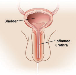 File:Urethritis (male).jpg
