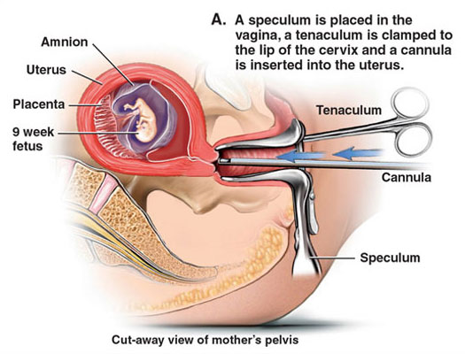 File:Surgical Abortion.png