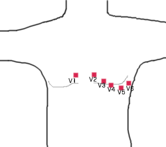 File:Chest Lead Placement.png