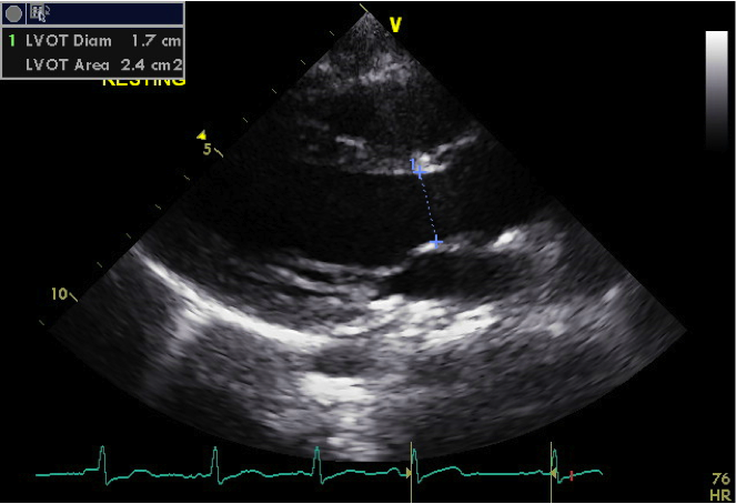 File:Figure 2. Left Ventricle Outflow Tract.png
