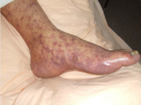 File:Rocky Mountain Spotted Fever rash on a foot.png