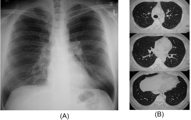 File:Chest high-resolution computed tomography.jpg