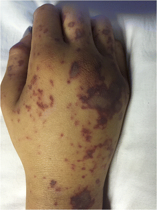 File:Figure 11. Clinical presentation of purpura fulminans in an individual with meningococcal septicaemia.png