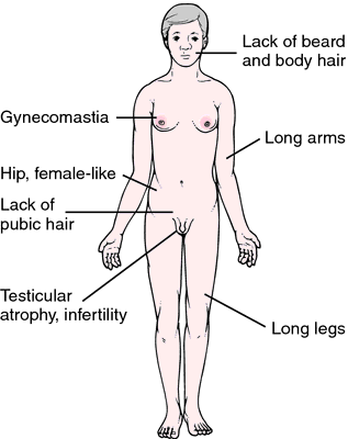 File:Common features of Kleinfelter syndrome in an adult male.png