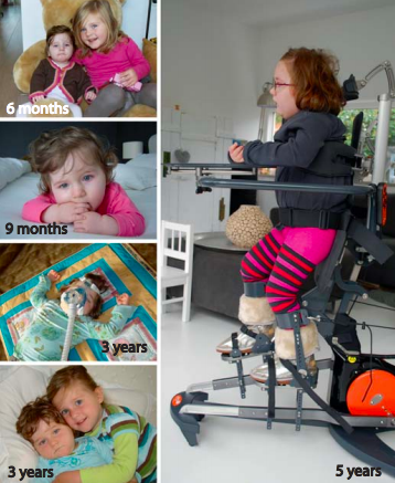 File:Progression of a girl with Rett Syndrome.png
