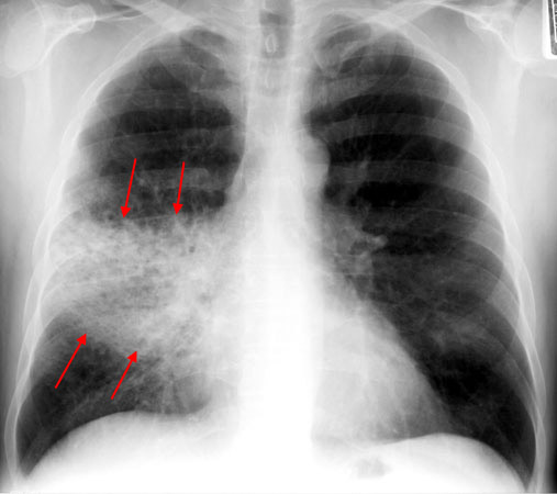 File:X-Ray of Pneumonia.jpg