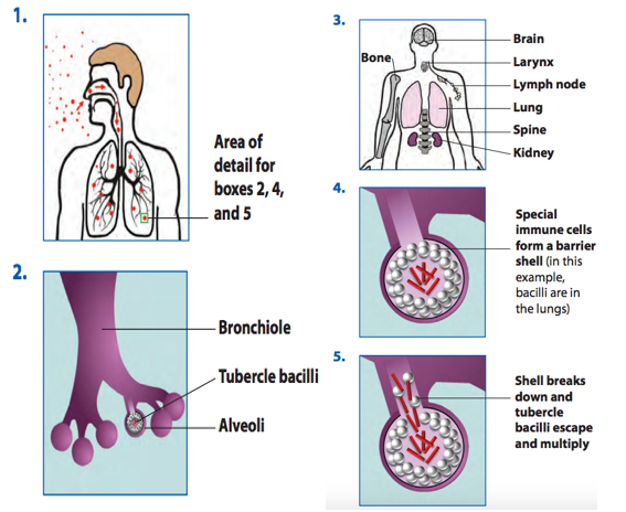 File:Figure 5. Pathogenesis of latent tuberculosis infection (LTBI) and TB disease (1) entry (2) alveoli (3) secondary sites (4) granuloma (5) broken down granuloma and escaping bacteria; from CDC; Web; March 4, 2017.png