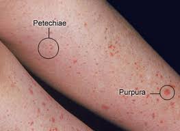 File:Mild Purpura and Petechiae presentation on the skin.jpg