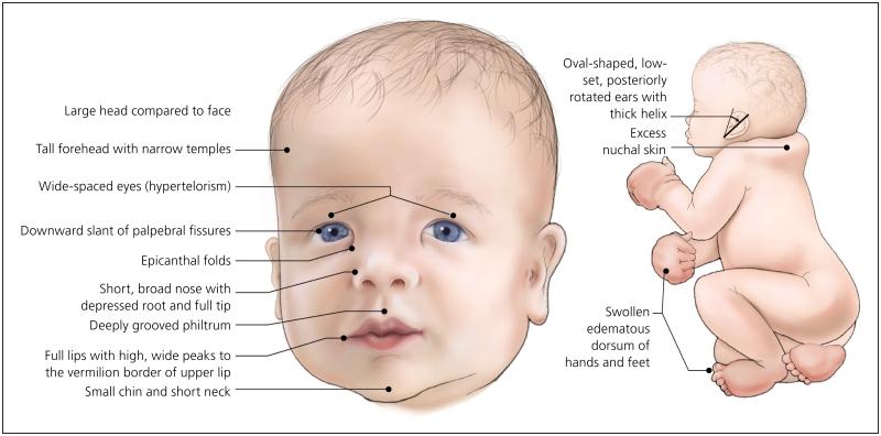 File:Newborn with Noonan Syndrome.jpg