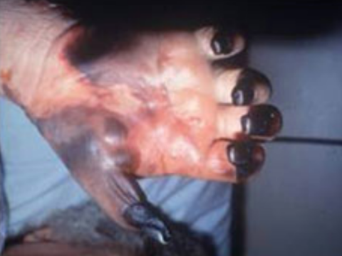 File:Necrosis of fingers due to fatal, untreated Rocky Mountain Spotted Fever.png