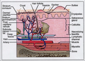 Figure 1: Illustration of the anatomical relationship between skin structures and different S. pyogenes infections. (4)