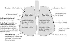 Figure 1. Mechanisms and radiographic features associated with airflow obstruction and restrictive ventilatory defects in patients with a history of tuberculosis