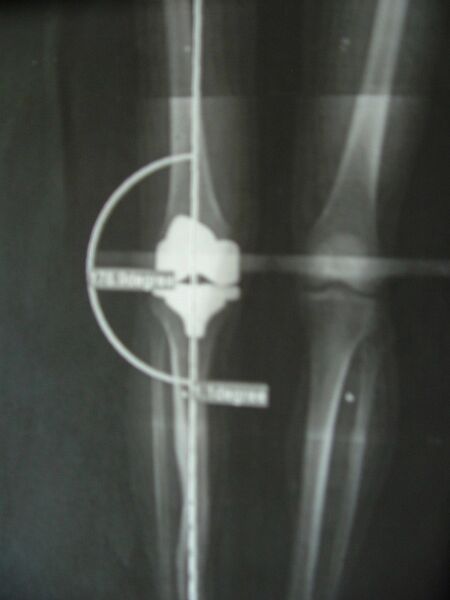 File:Knee Xray with implant.jpg