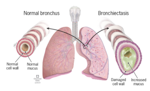 Figure 1.2d:  Normal versus damaged bronchus with bronchiectasis