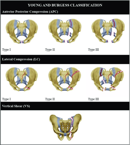 File:Pelvic fracture classificiations.png
