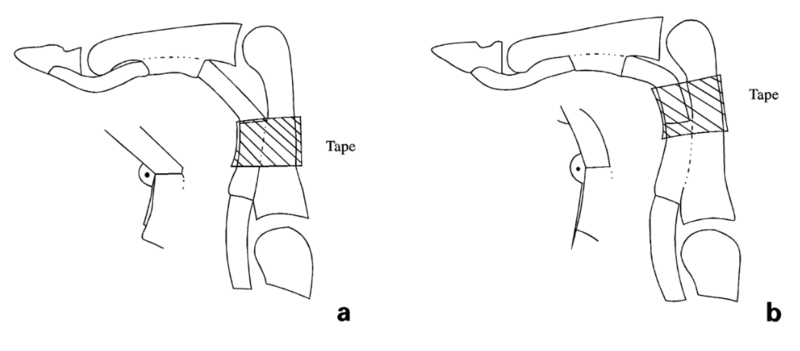 File:Taping over the distal edge of the A2 pulley (a) and taping over the distal end of the proximal phalanx (b).png