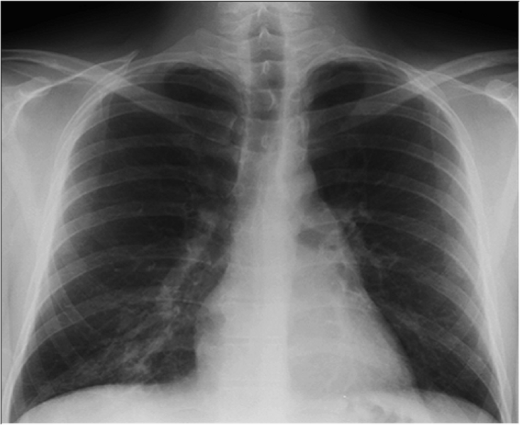 File:2 pneum lower right lobe xray.png