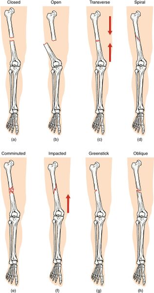 File:Types of Bone Fractures.jpg