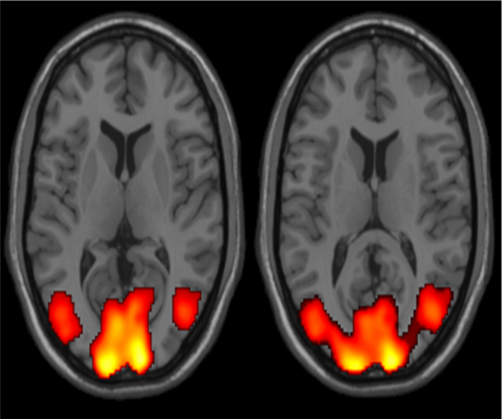 File:Visual cortex activation in fMRI (University of Alberta, n.d.).png