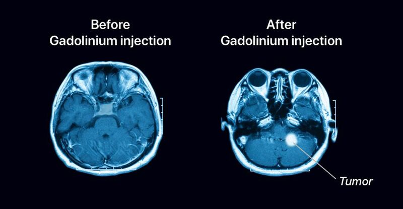 File:MRI images of before and after gadolinium contrast was used. (Drugwatch, n.d.).jpg