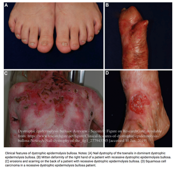 File:Clinical features of dystrophic epidermolysis bullosa.png
