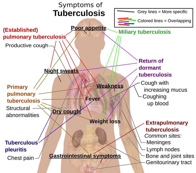 File:Tuberculosis Symptoms.jpg